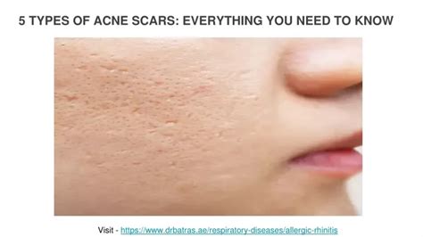 Ppt 5 Types Of Acne Scars Everything You Need To Know Powerpoint