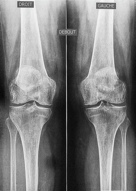 Osteoarthritis Of The Knees Photograph By Brian Gadsbyscience Photo