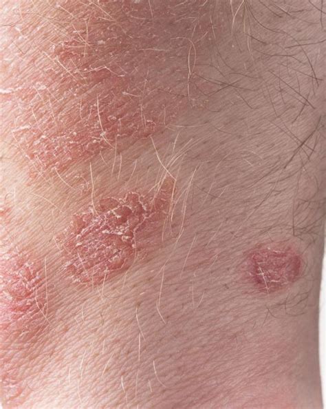 What Is Guttate Psoriasis With Pictures