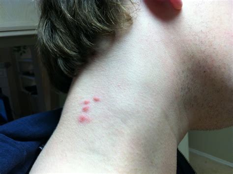 I Noticed Several Red Bumps On My Neck About 36 Hours Ago