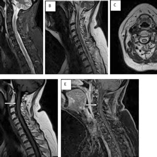 Cervical Spine MRI With LETM STIR And Sagittal And Axial T2 FLAIR A C