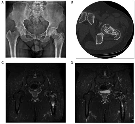 Malignant Transformation Of An Aneurysmal Bone Cyst Of The Femoral Neck