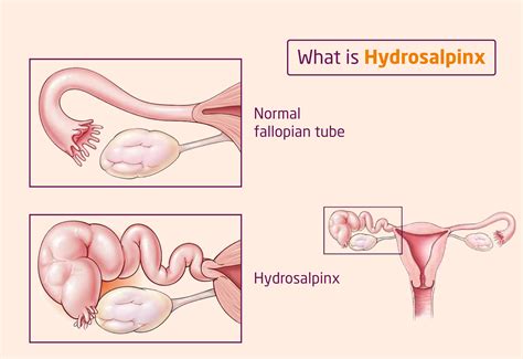What Is Hydrosalpinx Fallopian Tube Blockage