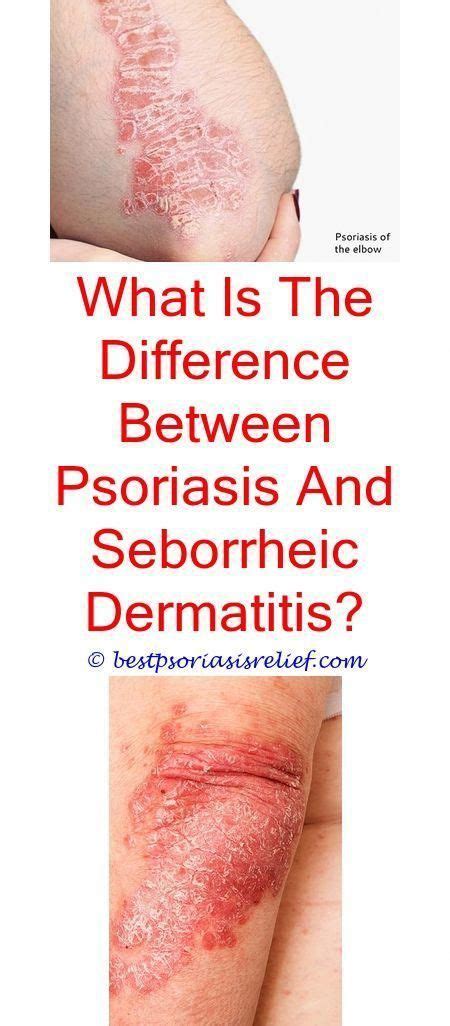 Everything You Need To Know About Psoriasis Treat Psoriasis