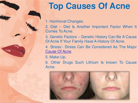 What Is Acne A Brief Users Guide For Parents Teens And The Rest Of