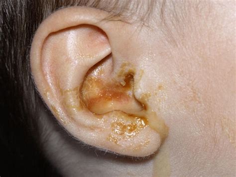 Ear Discharge Strong Causes And Prevention Healthpulls