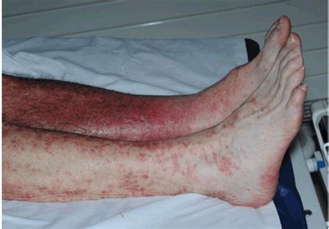 Full Text Systemic Lupus Erythematosus Presenting As Erythroderma