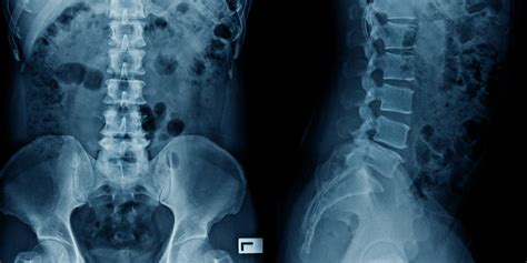 Radiografia Columna Lumbosacra Aphroditetrend