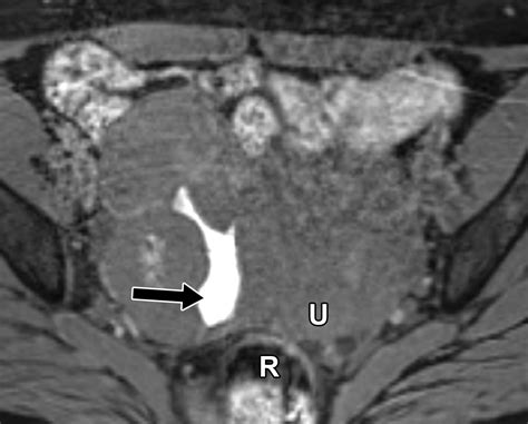 Multimodality Imaging Approach To Ovarian Neoplasms With Pathologic