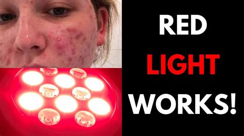 Red Light Therapy Testimonials For Acne Wrinkles And Anti Aging Youtube