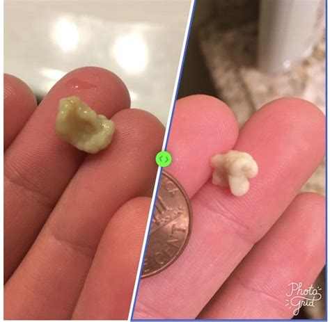 List 94 Pictures Photos Of Large Tonsil Stones Superb
