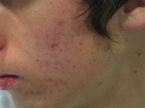 Diseases Of The Sebaceous Glands Acne Inflammatory Of The Face