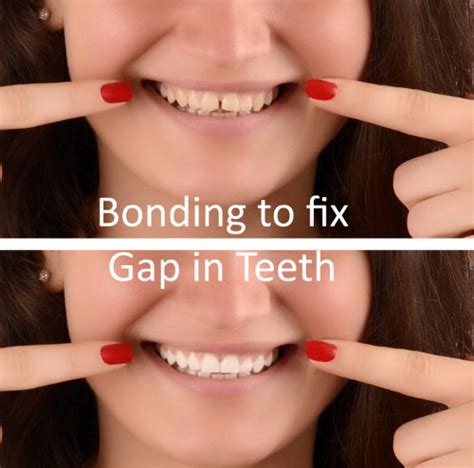 Dental Bonding Frisco Tx Bonding Cost Highland Oak Dental