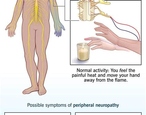 How Long Does It Take For Neuropathy To Vanish