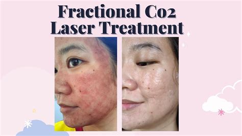 Fractional Co2 Laser Treatment 1st Session Youtube