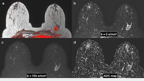 Triple Negative Subtype Left Breast Cancer Shown On Mri With