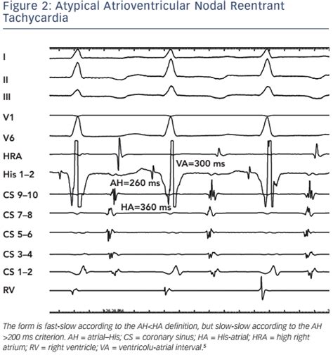 Figure Atypical Atrioventricular Nodal Reentrant Tachycardia