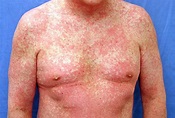 Picture of Morbilliform Drug Eruption on Face Picture Image on RxList.com