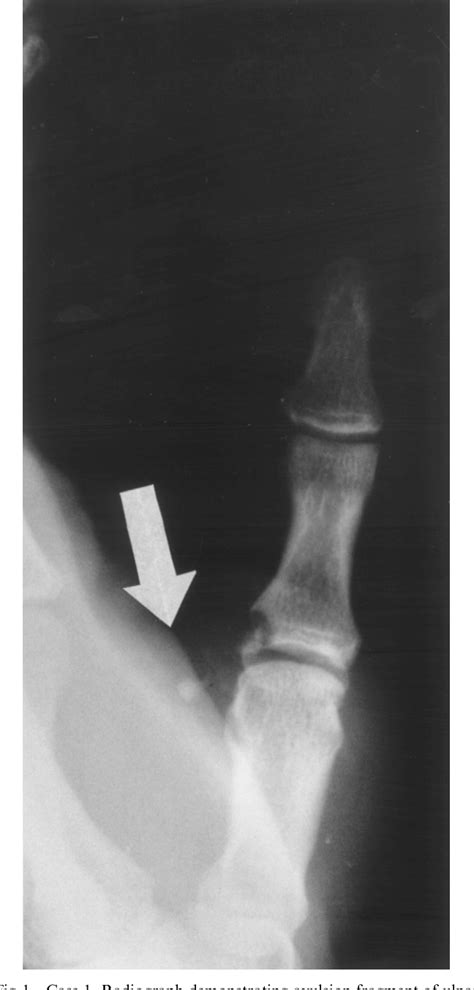 Figure 1 From The Two Level Ulnar Collateral Ligament Injury Of The