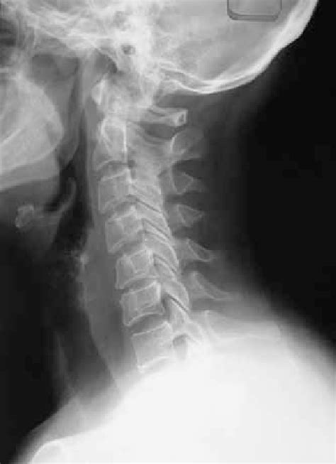 Lateral Cervical X Ray Demonstrating Early C56 Disc Degeneration With