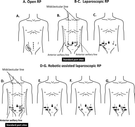 Skin Incision And Port Placement For The Radical Prostatectomy Rp A