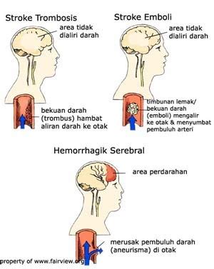 A hemorrhagic stroke can happen when bleeding in the brain damages brain cells. Intracerebral Hemorrhage Prognosis: Treatment for ...