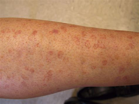 Disseminated Superficial Actinic Porokeratosis Spots On Legs Red Spots