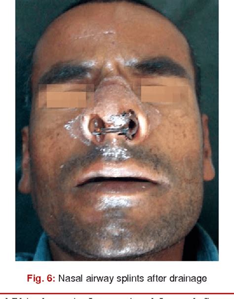 Nasal Septal Abscess A Retrospective Study Of 20 Cases In Kvg Medical