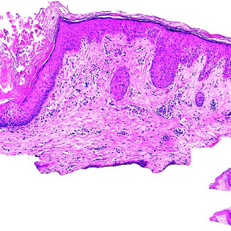 Dilatación E Hiperqueratosis En El Infundíbulo Folicular Junto Con Un