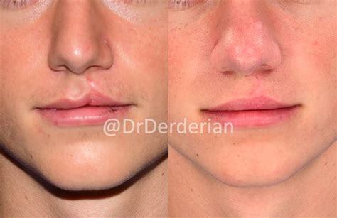 Adult Cleft Rhinoplasty — Dr Derderian — Plastic And Reconstructive Surgery