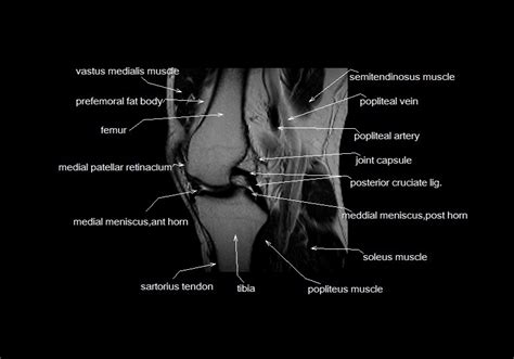 The images may also help physicians to distinguish normal, healthy tissues from dead tissues(2). mri knee anatomy | knee sagittal anatomy | free cross ...