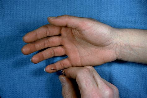 Ulnar Nerve Laceration Hand Surgery Source