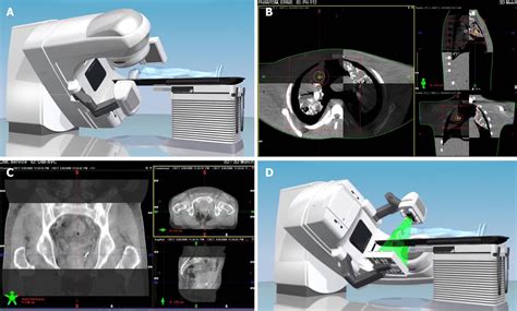 Progress In Image Guided Radiotherapy For The Treatment Of Non Small