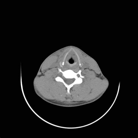 Acute Submandibular Sialadenitis Secondary To Ductal Stone Radiology