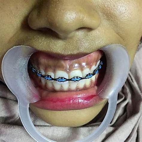 Pin By John Beeson On Orthodontic Braces In Orthodontics Braces Orthodontics Braces