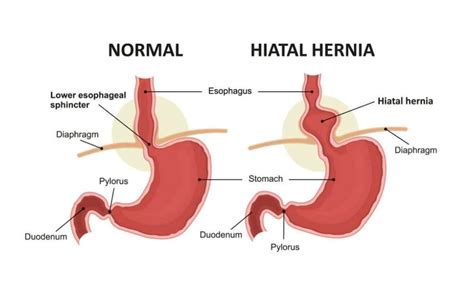 Can Hiatal Hernia Cause Dizziness Reasons Symptoms And Treatment Options
