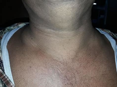 Swollen Supraclavicular Lymph Nodes Causes
