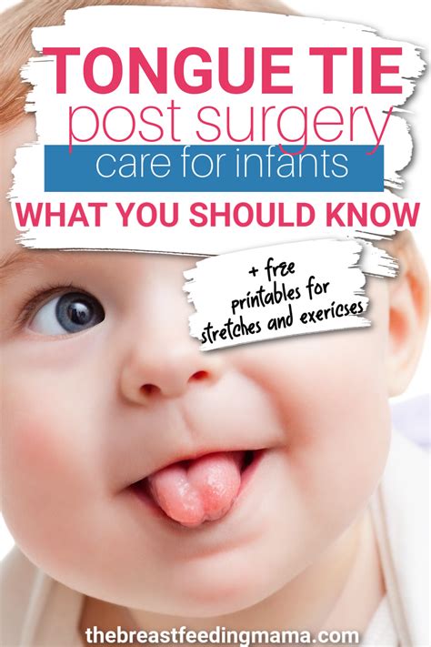 Tongue Tie Post Revision Care Tips For Success Printables 2024