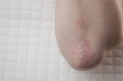 333 Flaky Rash Photos Free And Royalty Free Stock Photos From Dreamstime
