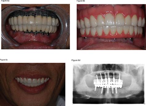 Full Mouth Rehabilitation With Implant Supported Prostheses For Severe