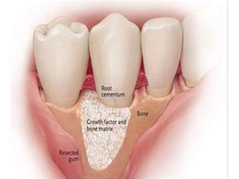 Bone Graft Bone Regeneration Implant And Sedation Dentistry Perth