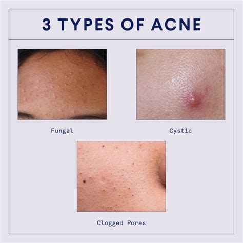 Types Of Acne Blackheads Whiteheads Fungal Cysts More