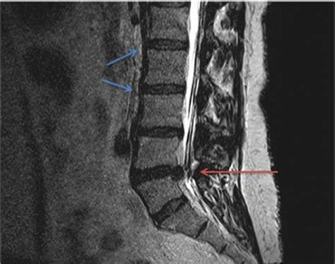 Lumbar Herniated Nucleus Pulposus Musculoskeletal And Connective