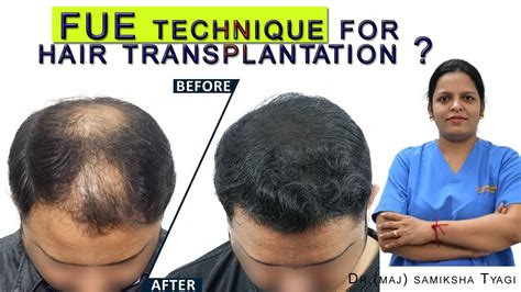Fue Technique For Hair Transplantation Fue Hair Transplant Procedure