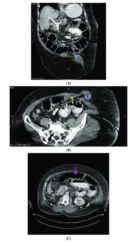 A Computed Tomography Imaging Of The Abdomen And Pelvis