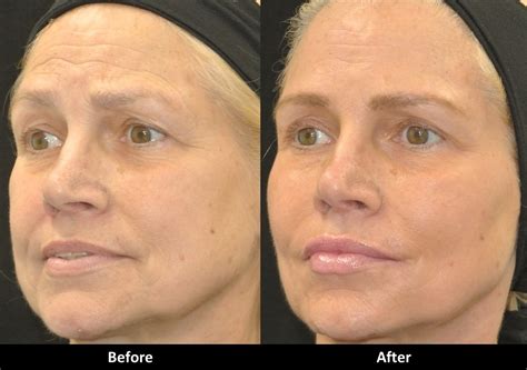 Juvederm Cheeks Before And After Photos