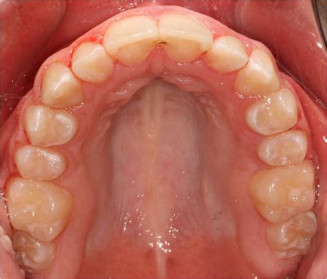 Bump on the roof of mouth is one of the dental conditions frequently seen by the dentist. All About Orthodontics | Chestnut Dental Associates ...
