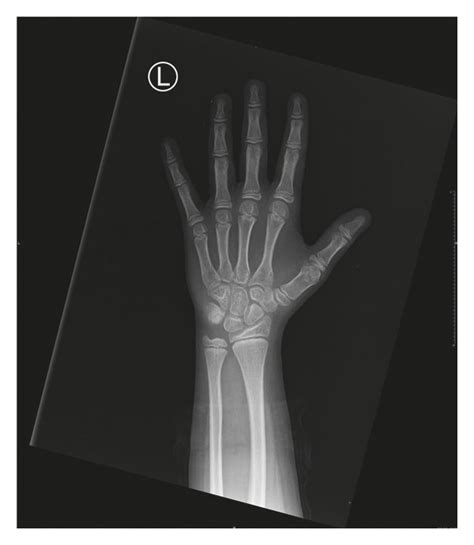 Pa Radiograph Of The Left Hand For Bone Age Evaluation A Radiograph Of