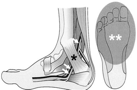 Tarsal Tunnel Syndrome Is An Entrapment Neuropathy Of The Posterior