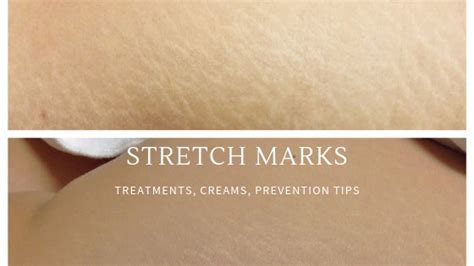 Tips For Treating And Preventing Stretch Marks Denver Laser Solutions